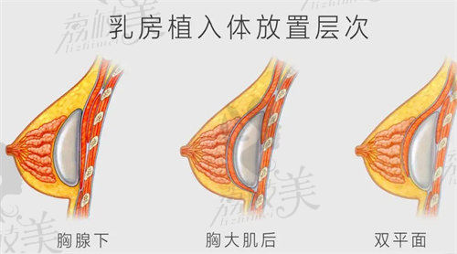 双平面隆胸示意图