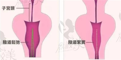 3D生物束帶緊縮術(shù)成效怎么樣？