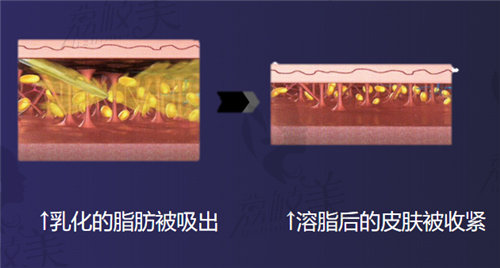 FSE气泡脂雕术的操作步骤2