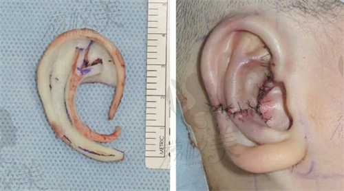 耳再造直埋法示意图