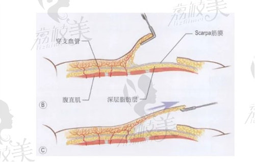 腹部肌层示意图