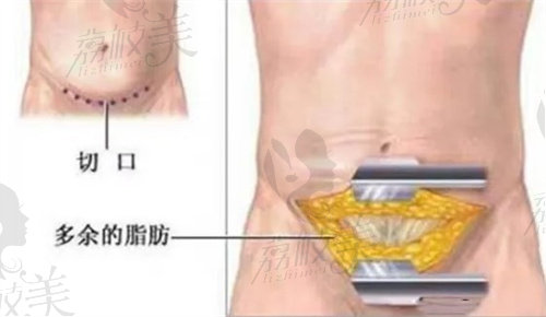 腹部脂肪示意图