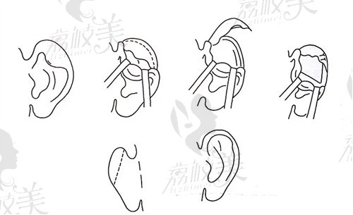 杯状耳矫正示意图