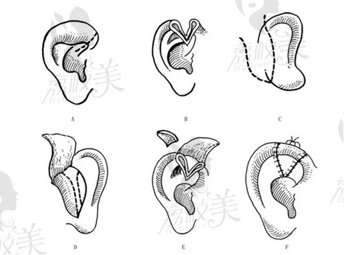 杯状耳矫正示意图