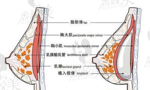 北京嘉禾整形医院假体隆胸项目