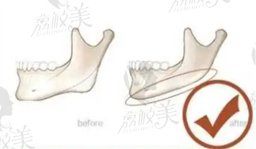 下頜角磨骨示意圖