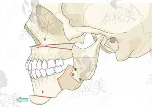 正頜手術示意圖