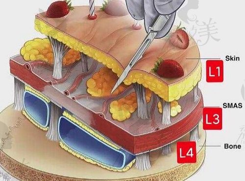 高亚东双平面拉皮层次