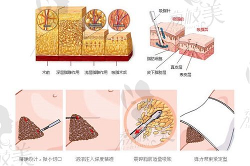 青岛华韩赵煜楠医生吸脂过程示意图