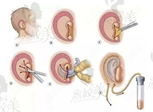 耳再造手术示意图