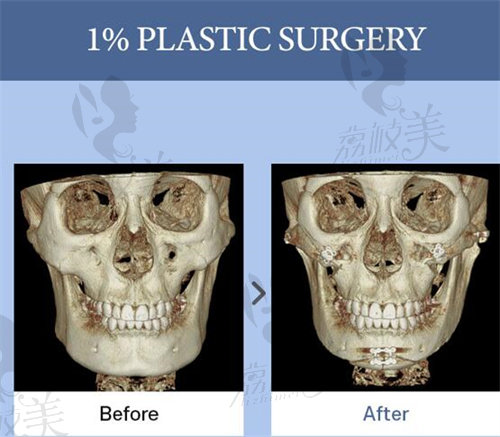 1%整形下巴截骨术前后