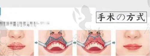 张曼医生m唇手术方式