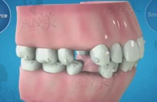 北京骨性龅牙矫正好的医院