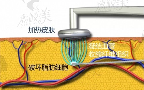 钻石精丨雕吸脂术原理