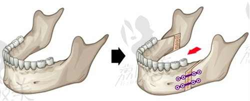 正颌手术示意图