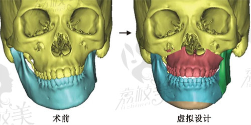 正頜手術示意圖