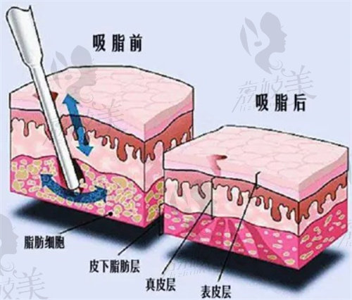 重庆北部宽仁医院吸脂整形