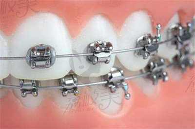 任艳医生在牙齿矫正方面的技术优势2