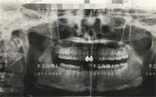 李志海下颌角CT