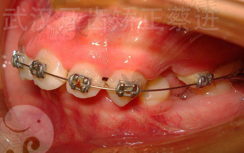 蔡进正畸矫正病例