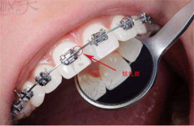 孙莉莉医生在牙齿矫正方面的技术优势1