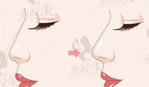 鼻整形结构变化示意图