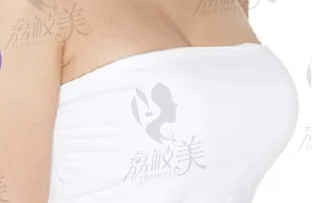 出彩医美丰胸成效怎么样