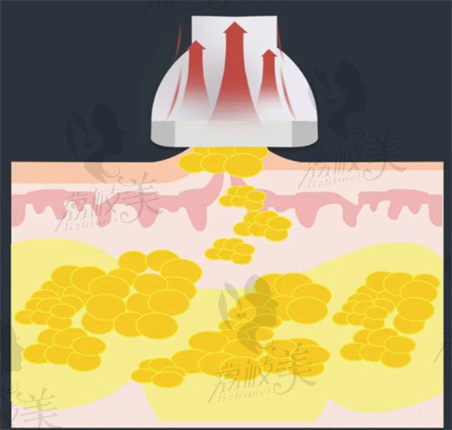 吸脂示意图