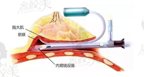 内窥镜隆胸示意图