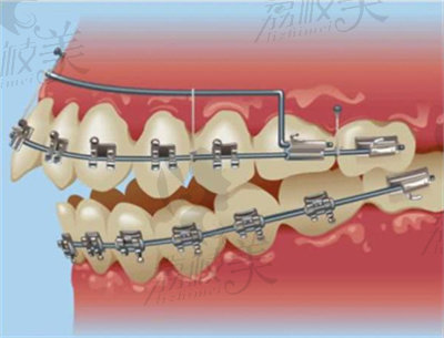 传统金属托槽矫正