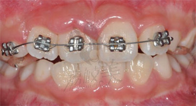梅小亮医生在牙齿矫正方面的技术优势2