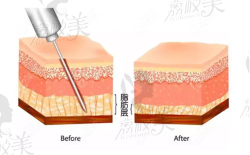 北京徐向民吸脂技術(shù)優(yōu)勢明顯