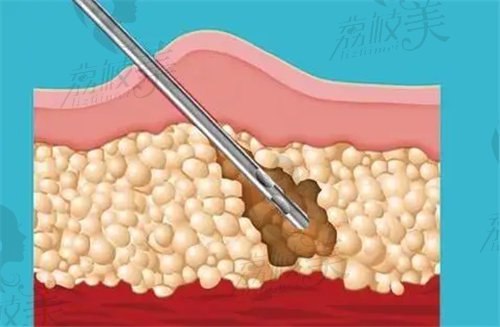 徐向民醫(yī)生做的腰腹吸脂技術(shù)不錯