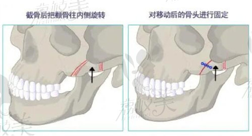 上海時(shí)光整形何晉龍顴骨展示