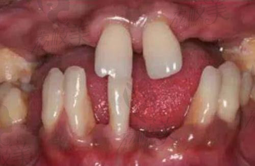 缺牙牙齿断裂掉牙等牙齿疾病