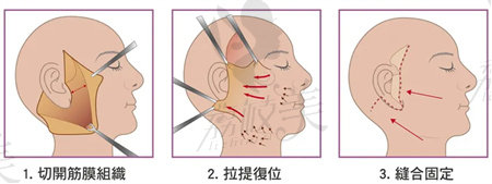 张晓健拉皮手术示意图