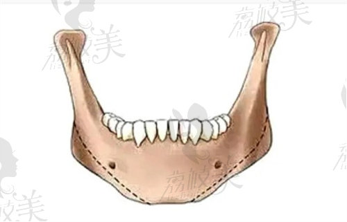 下颌角整形示意图