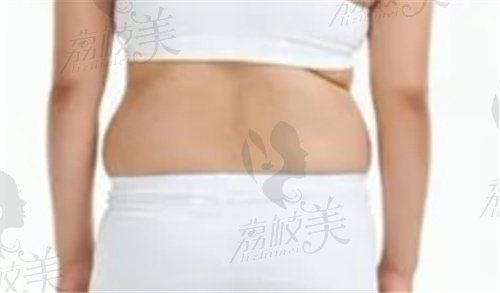 宁波这三家医院吸脂都不错