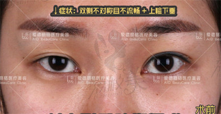 刘志刚双眼皮修复术前