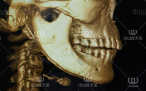 高俊明医生做下颌角手术技术高