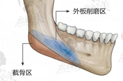 高俊明医生做下颌角手术有许多优势