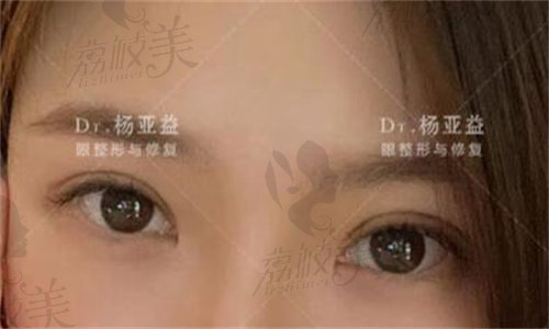 上海杨亚益双眼皮修复术后20天