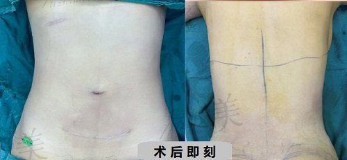 青岛华颜美腰腹环吸实例