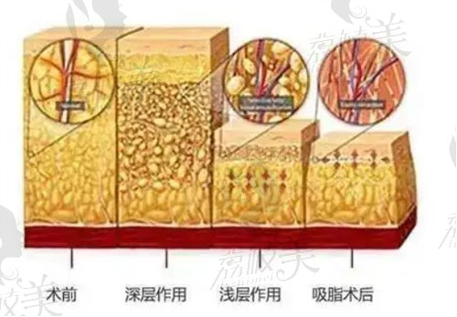 吸脂示意圖