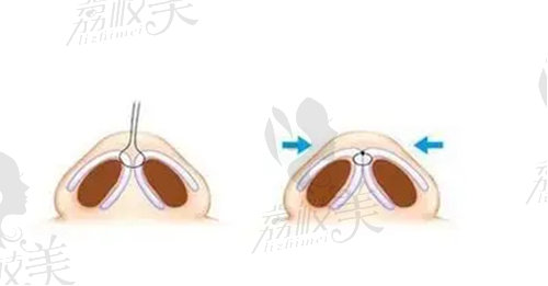 胡斌医生鼻整形技术优势有什么