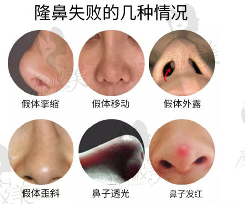 胡斌医生做鼻修复有效改善这些问题