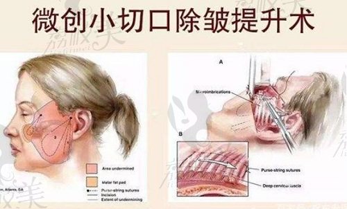 祝東升微創(chuàng)小切口提升術(shù)