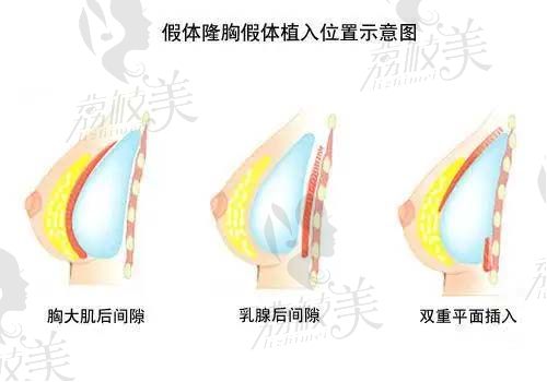 杭州薇琳隆胸技術(shù)怎么樣