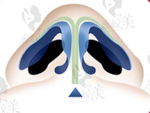 杭州薇琳隆鼻技术怎么样