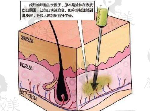 黎星生长因子取出